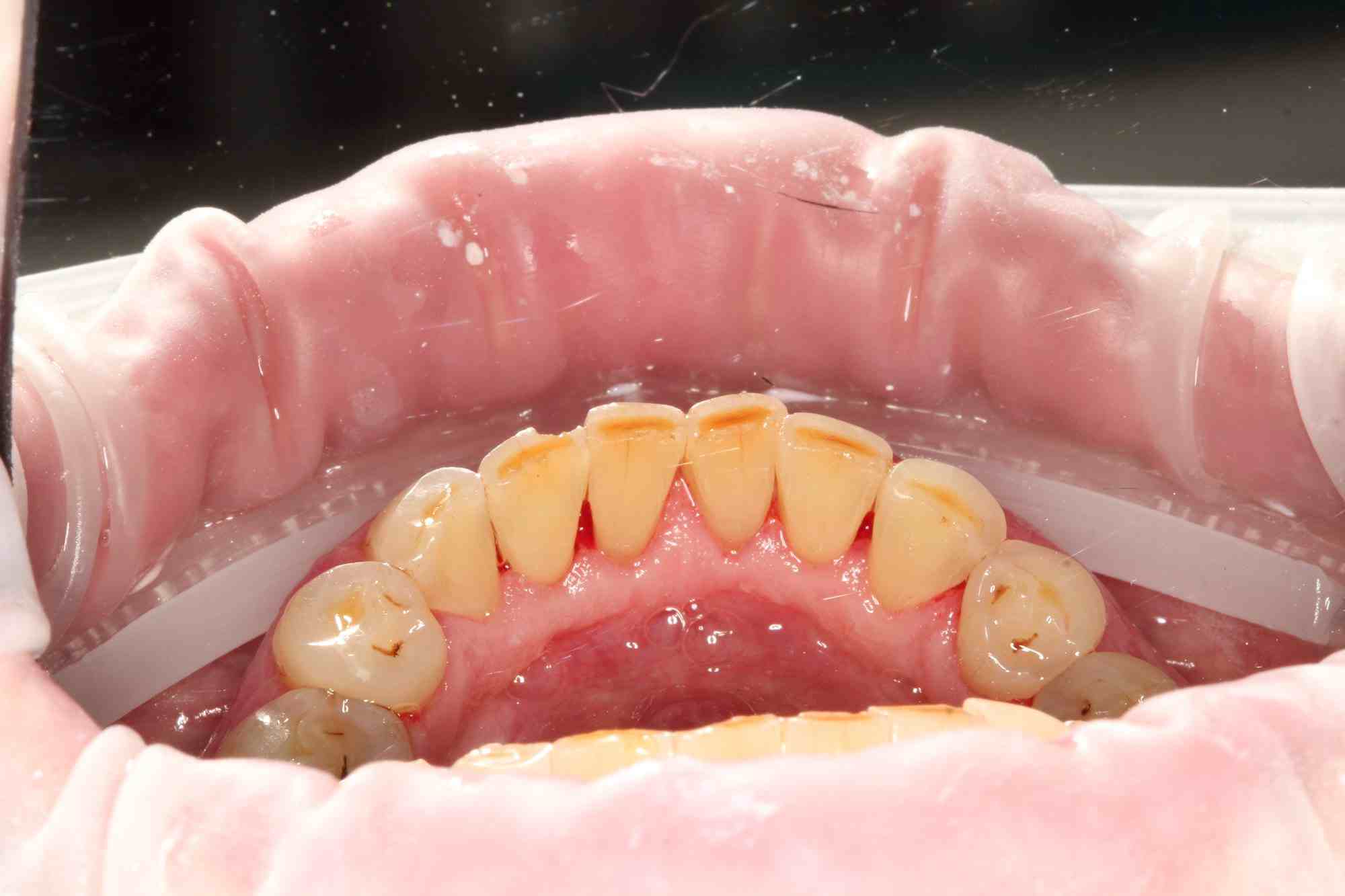 Професійна гігієна зубів у ReDental після очищення нальоту